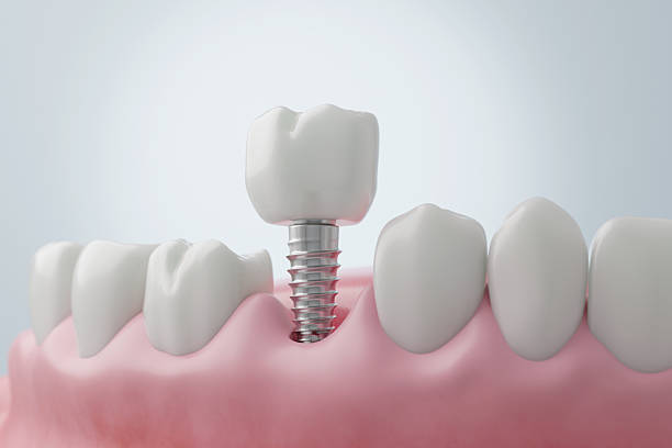 Dental implant procedure